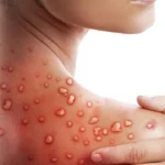 Informasi Penting yang Wajib Kamu Tahu! Mengenal Lebih Dekat Virus Cacar Monyet