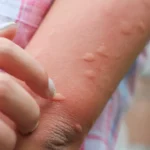 Bagaimana Mencegah Biduran pada Anak: Tips Ampuh yang Harus Anda Ketahui!