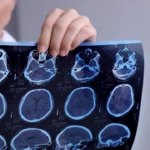 Manfaat Neurorestorasi dalam Pemulihan Pasien Stroke